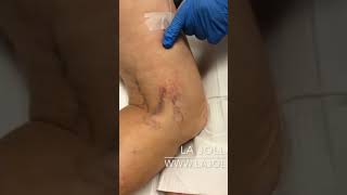 Sclerotherapy treatment for spiderveins 🤯 [upl. by Ronal]