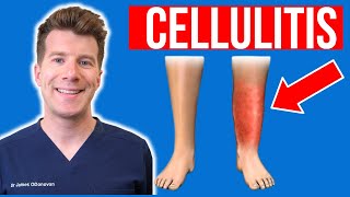 Doctor explains CELLULITIS skin infection  Causes symptoms treatment plus photos [upl. by Yllah731]