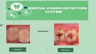 Dental Caries Detection System [upl. by Selohcin]