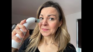 Review Do blackhead remover vacuums work and are they a good idea [upl. by Layol]