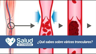 Salud en 3 Minutos Várices Tronculares [upl. by Garber]