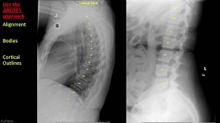 Introduction to Spine Radiographs [upl. by Islean91]