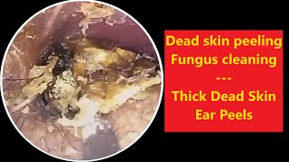 Thick Dead Skin Ear Peels 20231214 relaxing satisfying asmr [upl. by Yspyg]