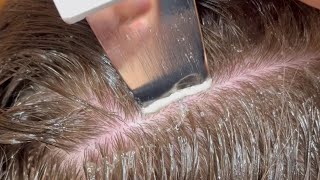 Scalp Treatment for DandruffBuildup [upl. by Stichter]