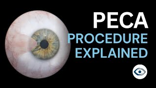 Pterygium Excision with Conjunctival Autograft PECA Procedure Explained  Precision Cornea Centre [upl. by Seligman]