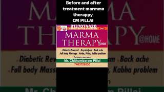 Before and after treatment in spinal cord prolabs marmma therappy kollam 8137074420 [upl. by Nohtanoj172]