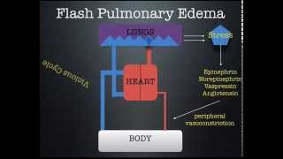 Flash Pulmonary Edema lecture by Dr Zevallos [upl. by Nerrad]