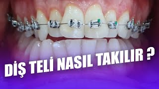 Diş Teli Nasıl Takılır Ortodontik Tel Tedavisi Nedir Ortodonti Tel Tedavisi Nasıl Yapılır [upl. by Wulfe]