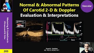 Normal amp Abnormal Patterns of Carotid Doppler [upl. by Rettig]