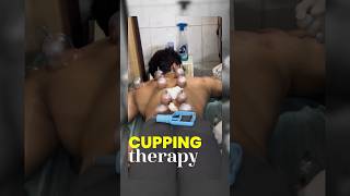 Cupping Therapy Cost 😳 amp Benefits 🙂‍↕️ [upl. by Engracia]