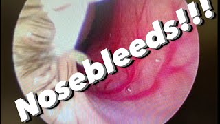 Nosebleeds epistaxis causes prevention treatments and more [upl. by Enecnarf527]