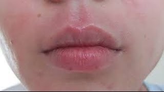 How to get rid of Perioral Dermatitis [upl. by Ayahc]