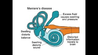 Menieres Disease [upl. by Lotte]