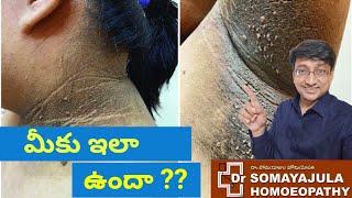 చర్మం నల్లగా మారుతుందా  Symptoms Cause amp Treatment of ACANTHOSIS NIGRICANS in TeluguDr Somayajula [upl. by Krissy]