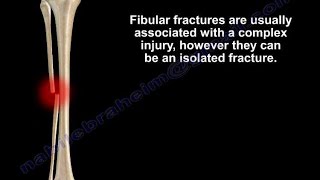 Fibular Fracture isolated Everything You Need To Know  Dr Nabil Ebraheim [upl. by Davina]