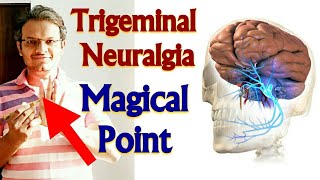 Acupressure Points For TRIGEMINAL NEURALGIA Acupressure For Trigeminal Neuralgia MADE EASY  HINDI [upl. by Nipahc106]