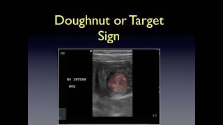 Bedside Ultrasound Diagnosis of Pediatric Intussusception [upl. by Reube519]