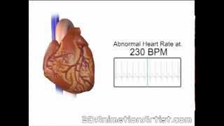 Normal Vs Accelerated Heart Rate [upl. by Awad]