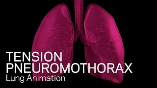 Tension Pneumothorax  Medical Animation [upl. by Masao]