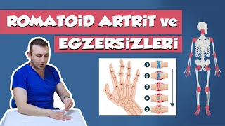 Romatoid Artrit  İltihaplı Eklem Romatizması  En Faydalı Egzersizler [upl. by Iaverne]