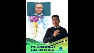 EVC HIPOESTESIS Y PARALISIS FASCIAL acv [upl. by Atsira]