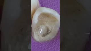 Teeth Cosmetic surgeryHow to restore teeth cavity hol dentistshortsviralshortteeth talk girl [upl. by Annawahs]