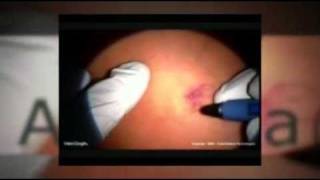 VeinGogh  Spider Angioma Treatment [upl. by Rodmann488]