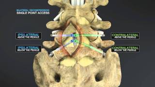 Medical Animation of Lumbar Stenosis Decompression [upl. by Mclyman]