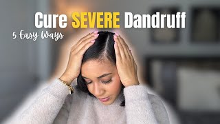 5 Easy Ways To Cure Severe Dandruff Seborrheic Dermatitis [upl. by Ardnekan609]