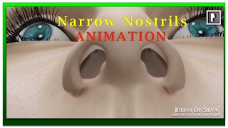 Rhinoplasty Animation  How can Wide Nostrils be Narrowed [upl. by Woolcott]