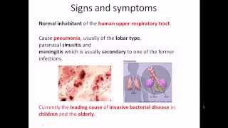 Streptococcus pneumoniae infection and disease [upl. by Aihsenal]