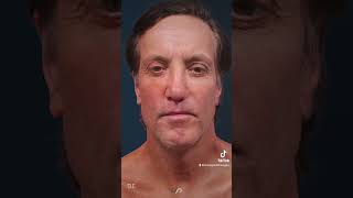 TRACELESS FACE amp NECK LIFT Before and After  Proof You NEED It [upl. by Ansel]