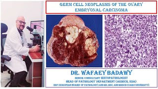 GERM CELL NEOPLASMS OF THE OVARY EMBRYONAL CARCINOMA BY DR WAFAEY BADAWY [upl. by Eimerej544]