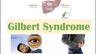 Gilbert Syndrome  Causes Genetics Pathogenesis Signs amp Symptoms Diagnosis Treatment [upl. by Sukin]