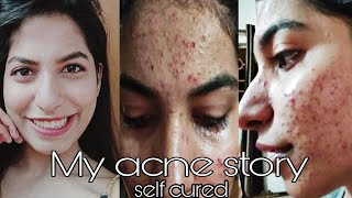 My pimple story Part 1 treatment and causes  How to reduce pimples and pimple scars  Acne [upl. by Cordalia]