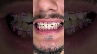 Braces Colors that make your teeth look Whiter [upl. by Nrol]