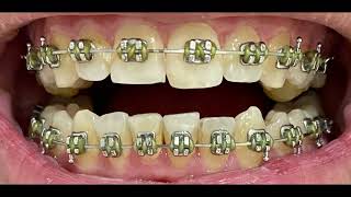 Before and After Braces timelapse over 2 Years Time monthly updates with two lower extractions [upl. by Benton]