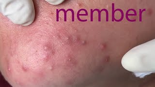 Acne Treatment Huong Da Nang membership 013   2023 [upl. by Astrea626]