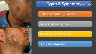 actinomycosis  Introduction Types Symptoms [upl. by Namajneb491]