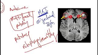 Video 217 Overview of Demyelinating Disorders Clinical Features Diagnostics and Risk Factors [upl. by Ylil]