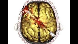 Brain Injury  Gunshot [upl. by Soutor]