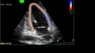 ABNORMAL STRAIN LONGITUDINAL ECHO [upl. by Ybloc]