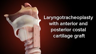 Medical Animation Anterior and Posterior Cricoid Split  Cincinnati Childrens [upl. by Huskey865]