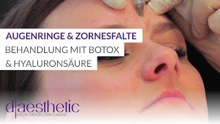 Augenringe Zornesfalte und Krähenfüße  Behandlung mit Hyaluronsäure und Botox  daesthetic [upl. by Haikan]