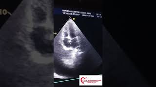 Constrictive pericarditis Echo  CP Echo  Echocardiography toacs  constrictive pericarditis [upl. by Odraboel]