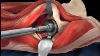 Anterior Hip Replacement Animation [upl. by Kcirdnekal]