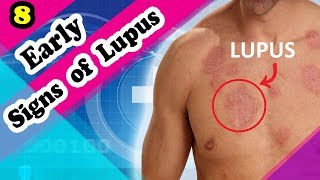 7 Signs and Symptoms of Lupus You Should Know [upl. by Hotchkiss]