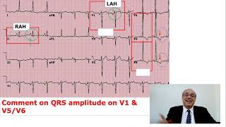 EKG Trainer Case 5 Answer [upl. by Mukul647]