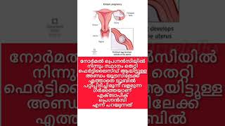 Ectopic pregnancy Reasons treatment pregnancycaremalayalam babyremidies [upl. by Bethezel]