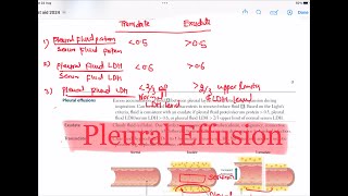 Pleural Effusion  Transudate Vs Exudate Respiratory 47  First Aid USMLE Step 1 in UrduHindi [upl. by Allicerp530]